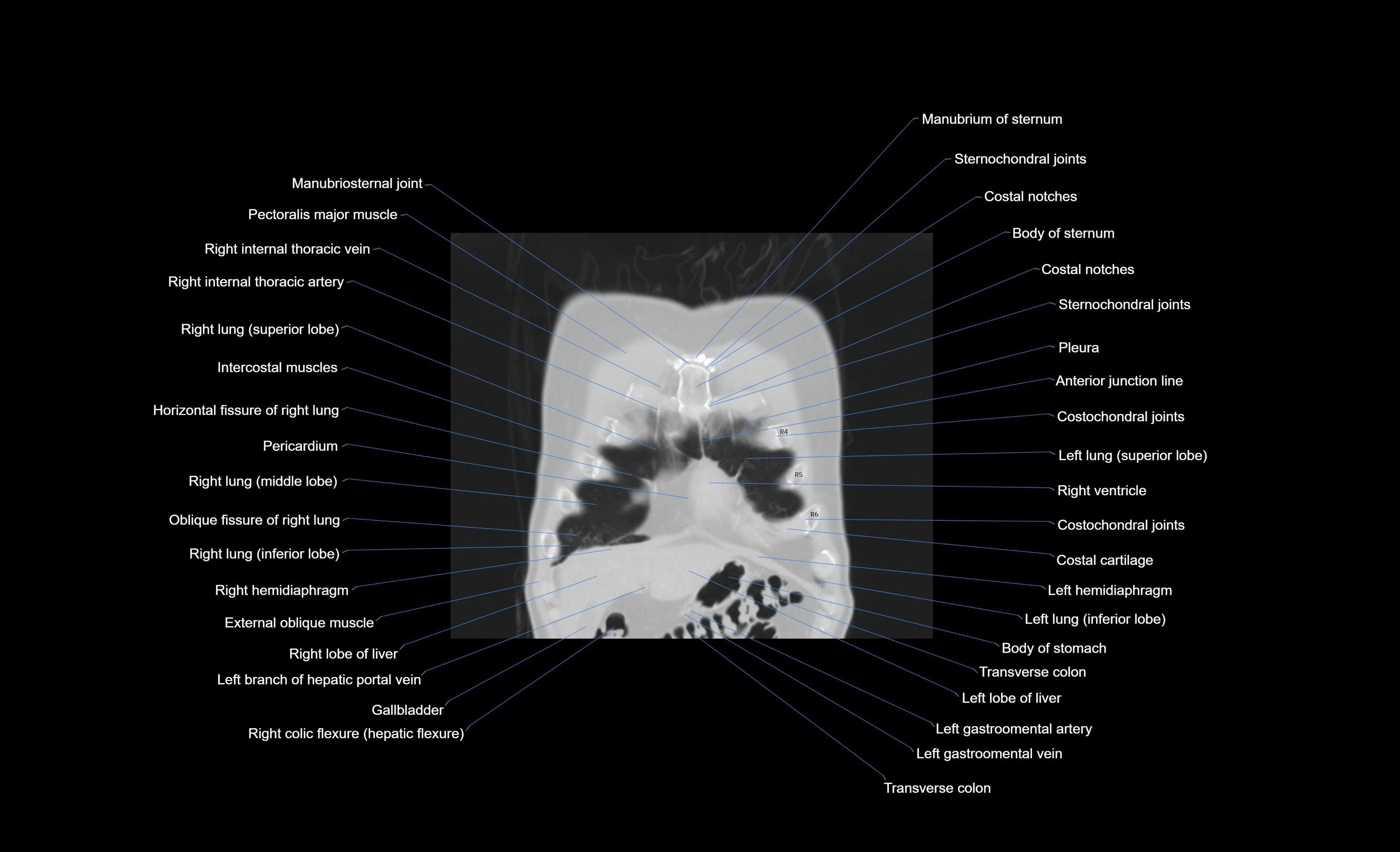 CT chest (thorax) labelled coronal cross sectional anatomy radiology image-00098.webp
